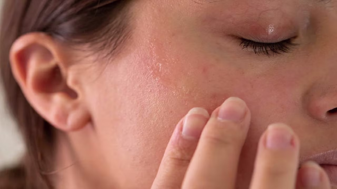 dry skin